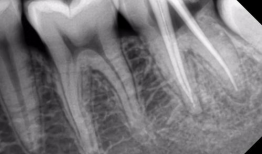 根管治疗视频,从视频学习根管治疗技巧与流程